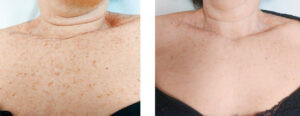 Foto prima e dopo del trattamento laser per macchie cutanee